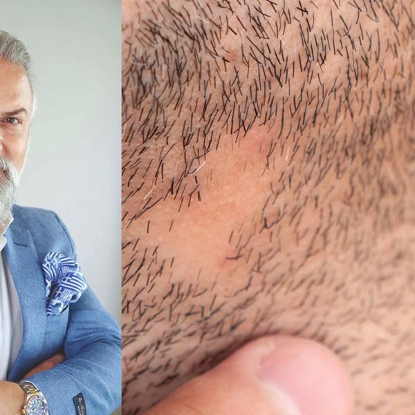 Όλα όσα πρέπει να γνωρίζεις για την εμφύτευση γενιών
